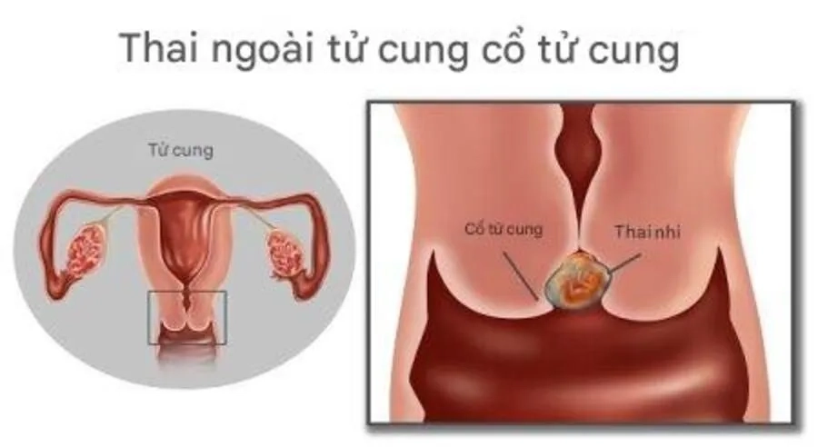 Thai ngoài tử cung ở cổ tử cung có thể gây chảy máu nhiều, đe dọa tính mạng và ảnh hưởng đến khả năng sinh sản sau này