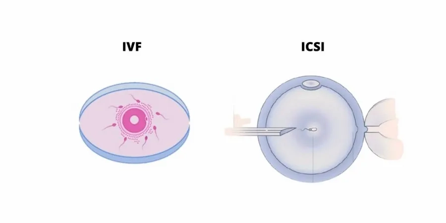 Phân biệt tiêm tinh trùng vào bào tương noãn ICSI và IVF