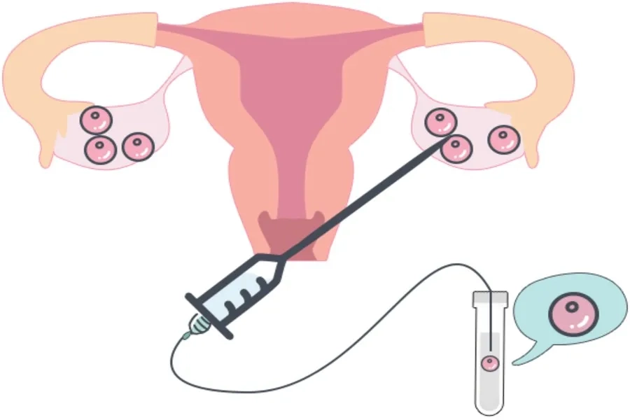Chọc hút noãn lấy trứng để chuẩn bị cho quá trình tinh trùng