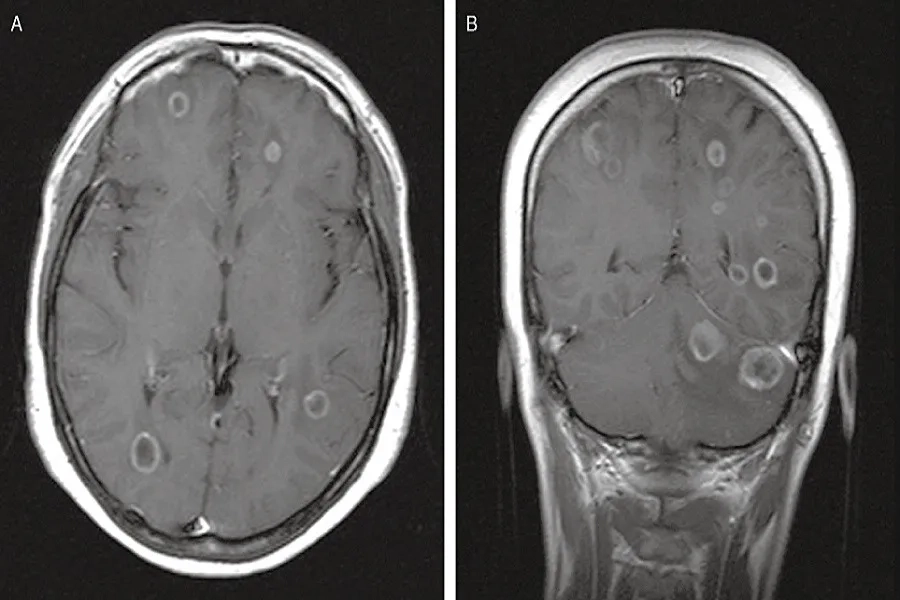 Ung thư cổ tử cung di căn não làm giảm chất lượng sống và tiên lượng điều trị