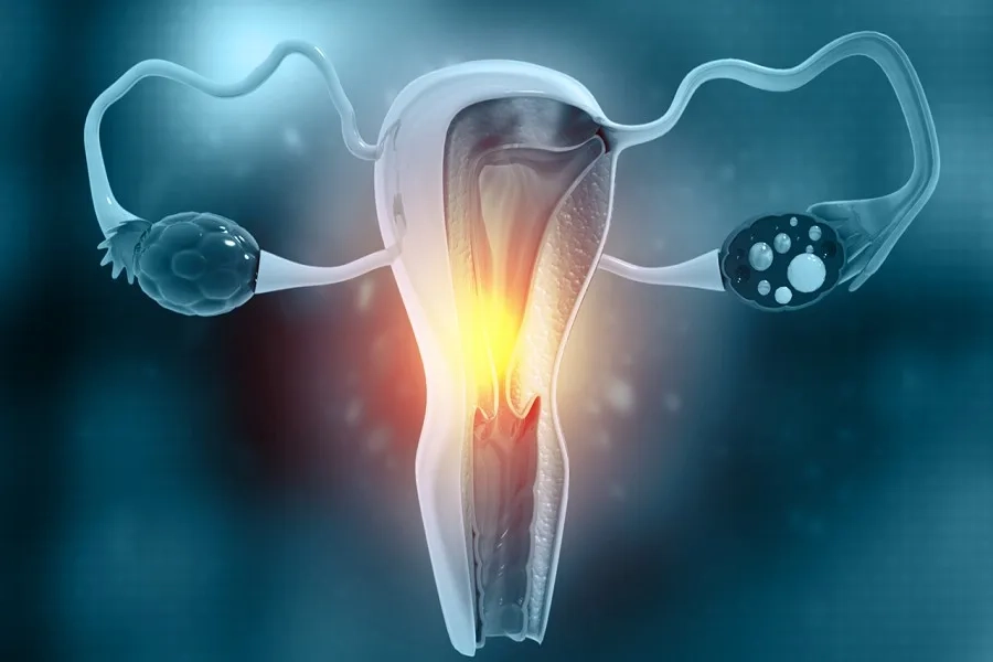 Ung thư cổ tử cung di căn có thể lan đến phổi, gan, xương khiến quá trình điều trị phức tạp hơn và ảnh hưởng đến tiên lượng sống