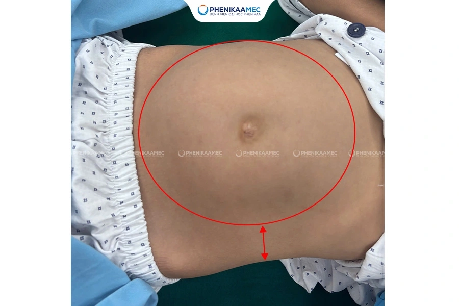 Phẫu thuật thành công u quái buồng trứng “khổng lồ” cho bé gái 9 tuổi