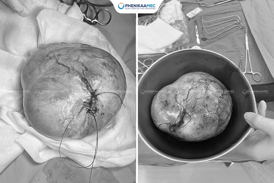 Phẫu thuật thành công u quái buồng trứng “khổng lồ” cho bé gái 9 tuổi