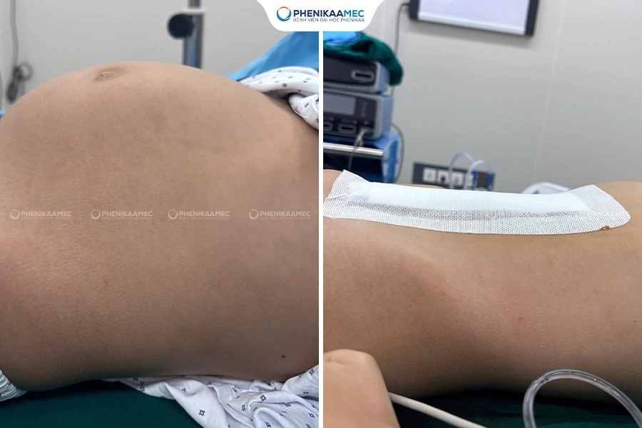 Phẫu thuật thành công u quái buồng trứng “khổng lồ” cho bé gái 9 tuổi