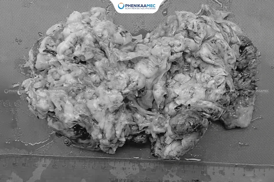 Phẫu thuật thành công u quái buồng trứng “khổng lồ” cho bé gái 9 tuổi