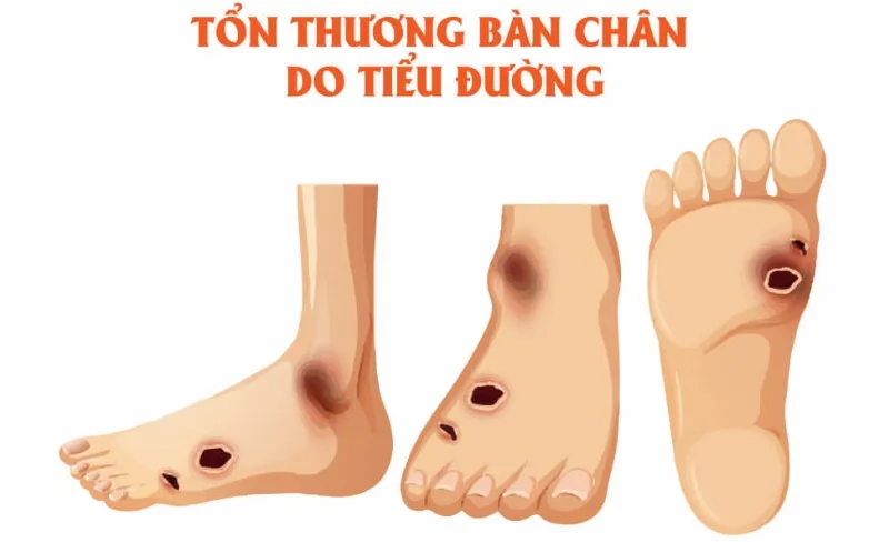 Tiểu đường có thể ảnh hưởng đến chức năng thận