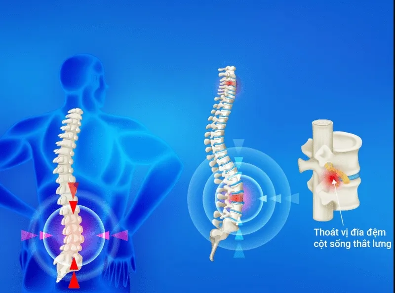  Mổ thoát vị đĩa đệm Microdiscectomy được chỉ định khi bệnh nhân bị thoát vị đĩa đệm thắt lưng