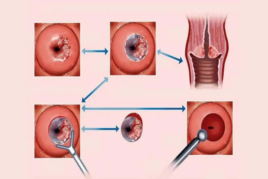 Khoét chóp cổ tử cung - phương pháp hiệu quả giúp loại bỏ tổn thương tiền ung thư sớm