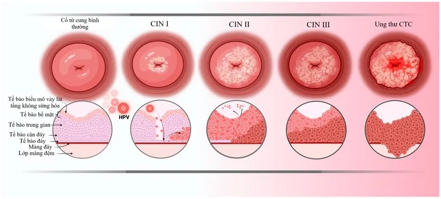 Các giai đoạn tiến triển tiền ung thư cổ tử cung trước khi trở thành ung thư cổ tử cung thực sự