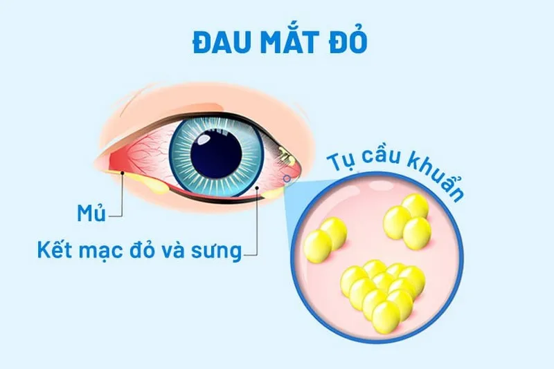 Đau mắt đỏ dễ lây lan khi bệnh bắt nguồn từ virus, vi khuẩn