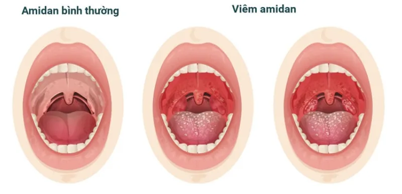  Viêm Amidan dễ xảy ra do virus, vi khuẩn tấn công 