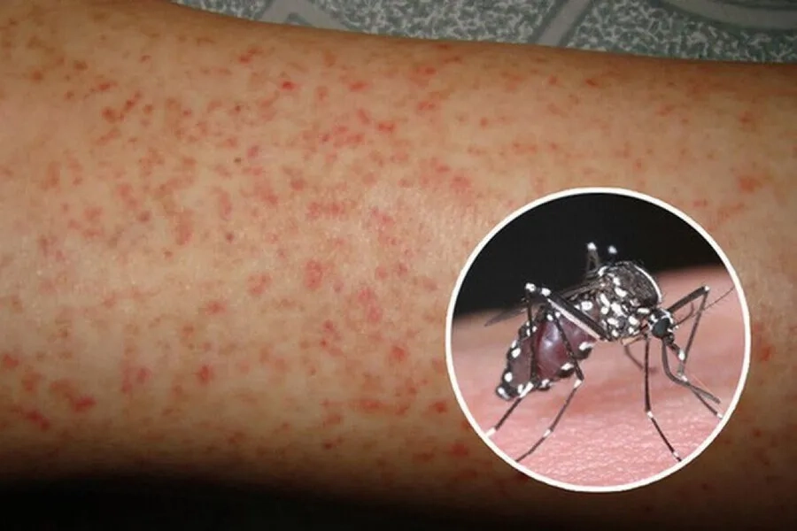 Bệnh sốt xuất huyết do virus Dengue lây truyền qua muỗi đốt gây nên