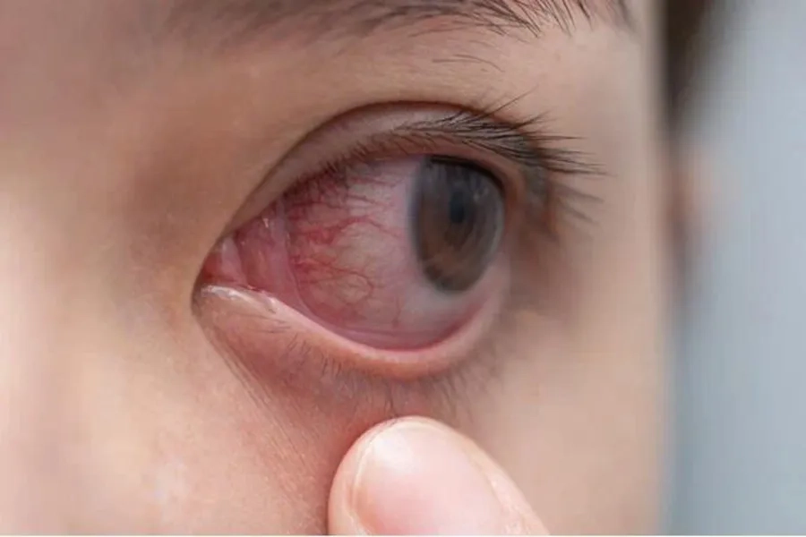 Sốt xuất huyết có thể gây biến chứng giảm thị lực