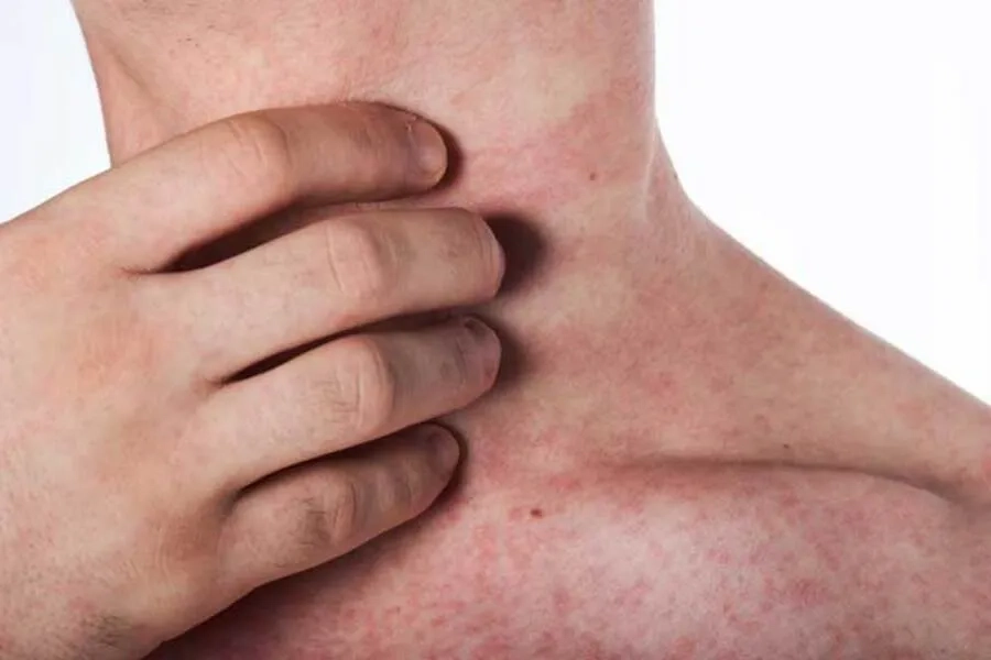 Giai đoạn nguy hiểm nhất của sốt xuất huyết là từ ngày 3 - 7 với biểu hiện xuất huyết dưới da, niêm mạc, nội tạng 