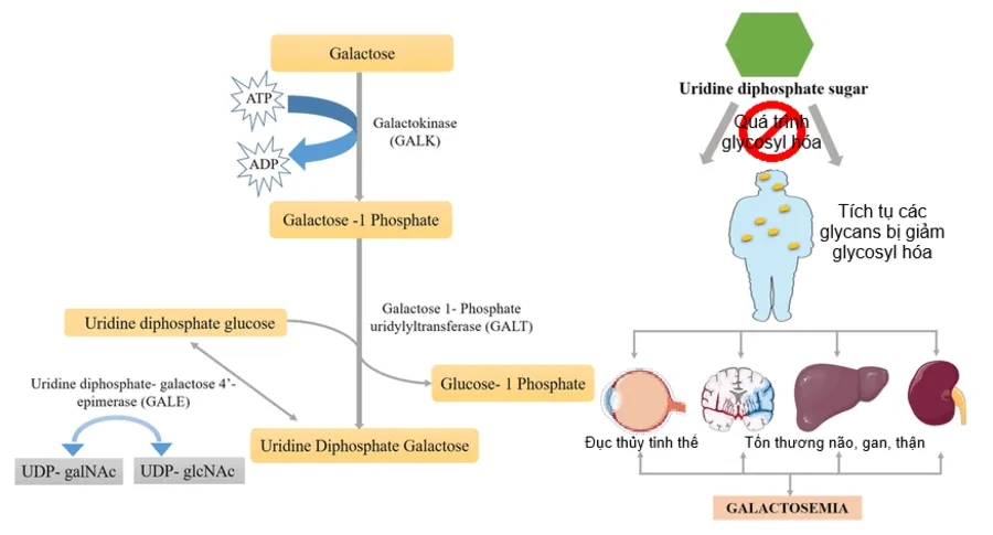 Cơ chế gây rối loạn chuyển hóa galactose gây tổn thương não, gan, thận