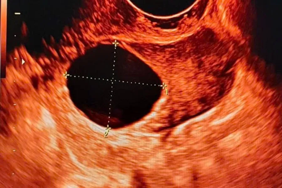 Chất lượng nang noãn là yếu tố quan trọng hỗ trợ tăng cơ hội thụ thai