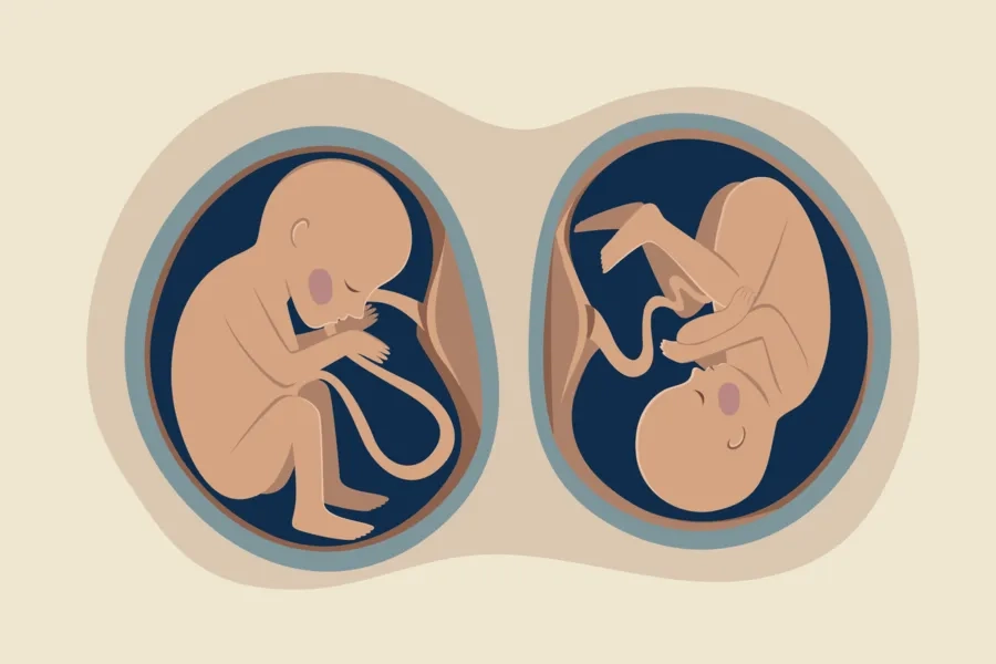 IUI làm tăng nguy cơ mang đa thai cao hơn bình thường