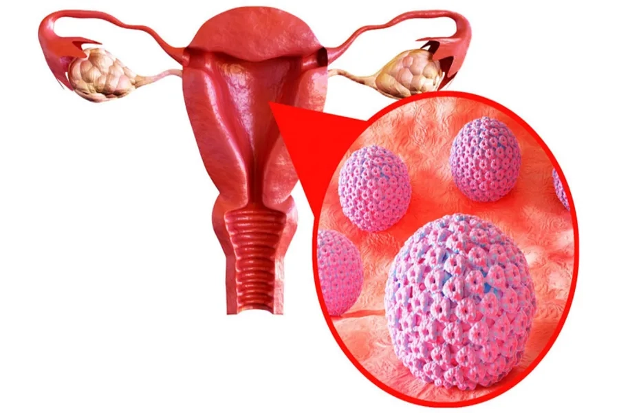 Virus HPV là tác nhân chính gây nên ung thư cổ tử cung ở phụ nữ