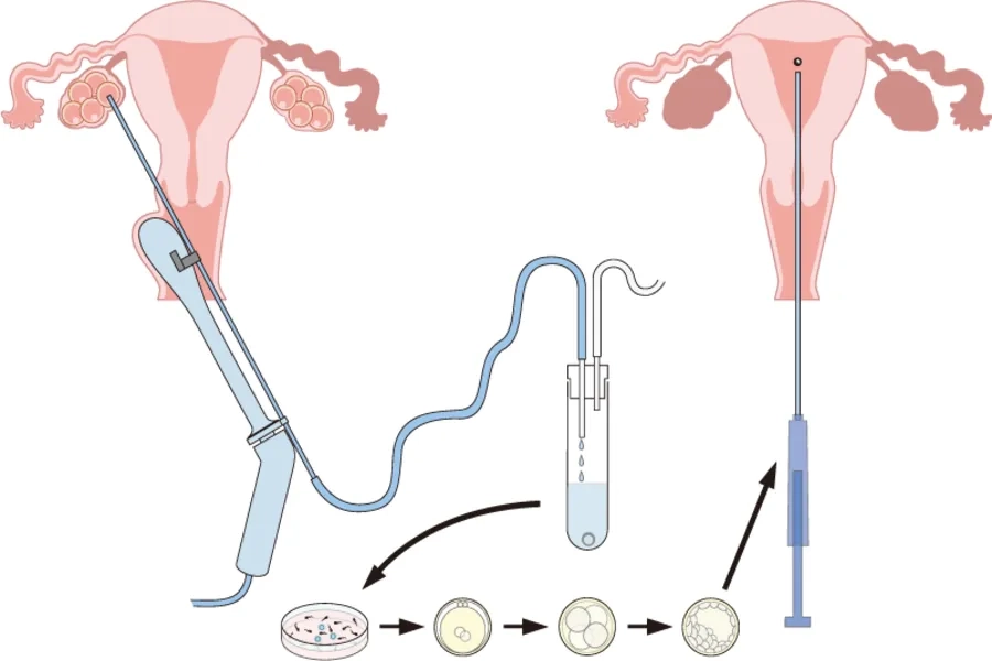 Quy trình các bước IVF (thụ tinh trong ống nghiệm)