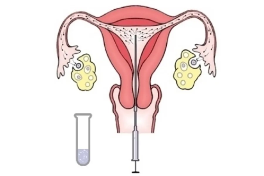 Quy trình IUI bơm tinh trùng vào tử cung tăng cơ hội thụ thai
