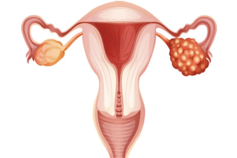 Điều kiện để thực hiện IUI là buồng trứng và ít nhất 1 ống dẫn trứng phải thông suốt để tạo cơ hội tinh trùng gặp trứng