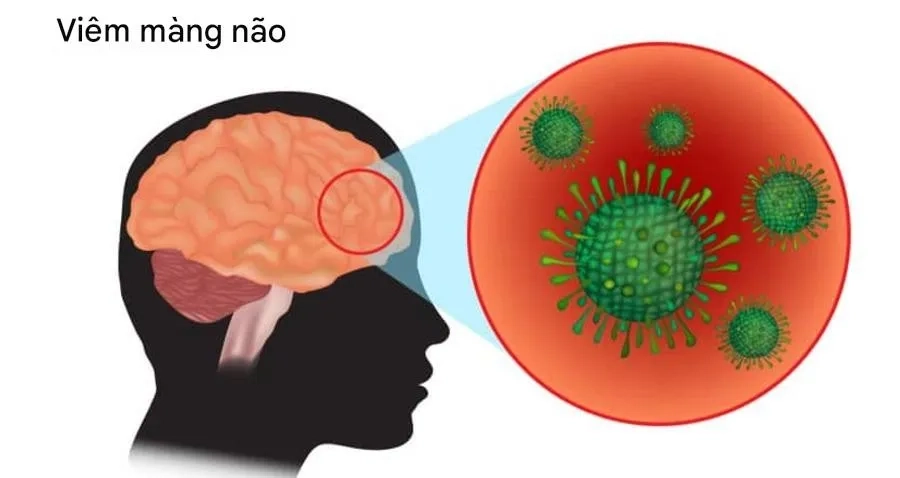 Tiêm vắc xin viêm não mô cầu BC giúp bảo vệ cơ thể khỏi viêm màng não mô cầu nguy hiểm