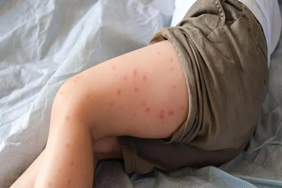 Xuất huyết dưới da là giai đoạn nguy hiểm cần được điều trị đúng cách để tránh biến chứng