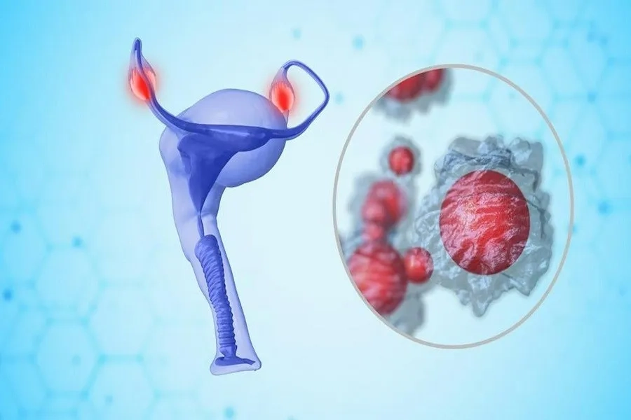 Yếu tố di truyền và tiền sử gia đình có thể dẫn đến ung thư buồng trứng
