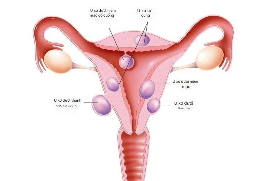 Kích thước u xơ từ 6 cm trở lên được xem là “to”