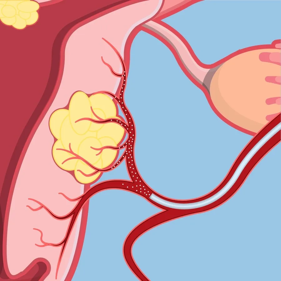 Nút mạch tử cung là kỹ thuật can thiệp ít xâm lấn giúp làm giảm kích thước u xơ