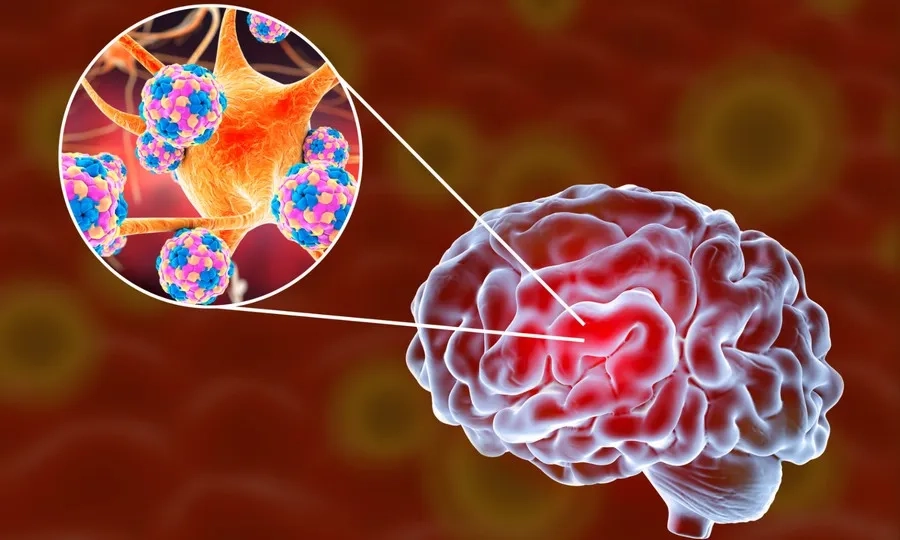 Viêm não mô cầu BC là bệnh nhiễm khuẩn cấp tính do vi khuẩn não mô cầu nhóm B và C gây ra