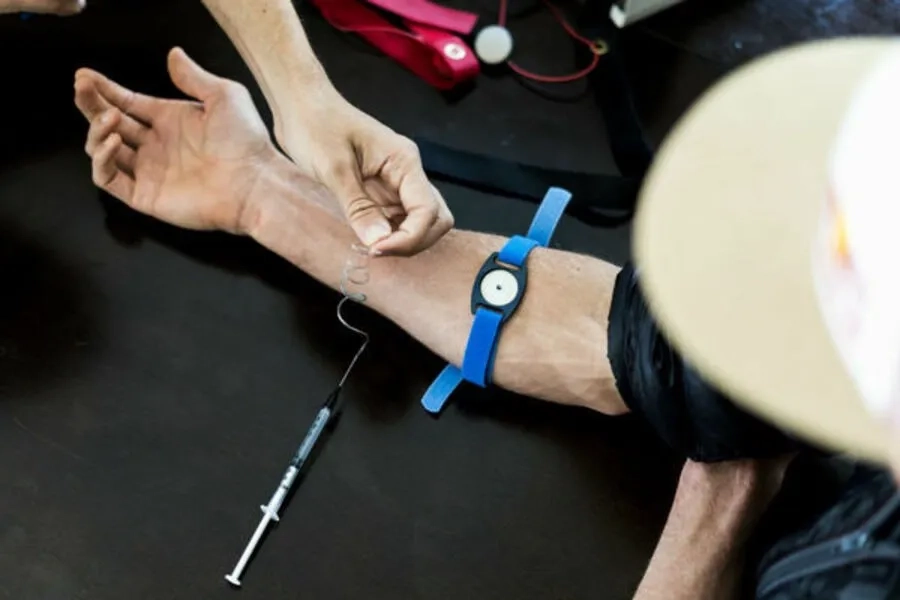 Xét nghiệm mồ hôi là tiêu chuẩn vàng trong chẩn đoán xơ nang