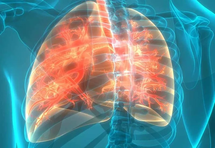 Bệnh xơ nang có thể gây tắc nghẽn đường dẫn khí và ống tụy