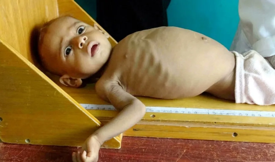 Suy dinh dưỡng là một trong những biến chứng nguy hiểm của xơ nang