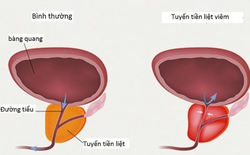 Viêm tuyến tiền liệt có nguy cơ ảnh hưởng tới khả năng sinh sản