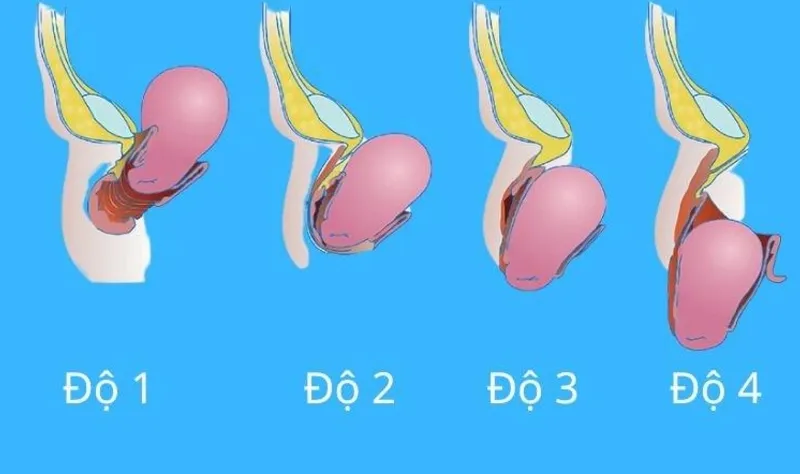 Sa bàng quang ảnh hưởng nghiêm trọng tới chất lượng cuộc sống nếu không điều trị kịp thời và đúng cách