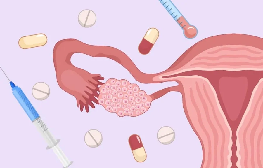 Buồng trứng tăng kích thước bất thường trong hội chứng OHSS