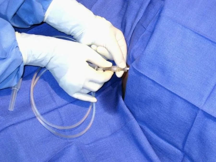 Chọc hút dịch ổ bụng giúp giảm triệu chứng trong quá kích buồng trứng nặng