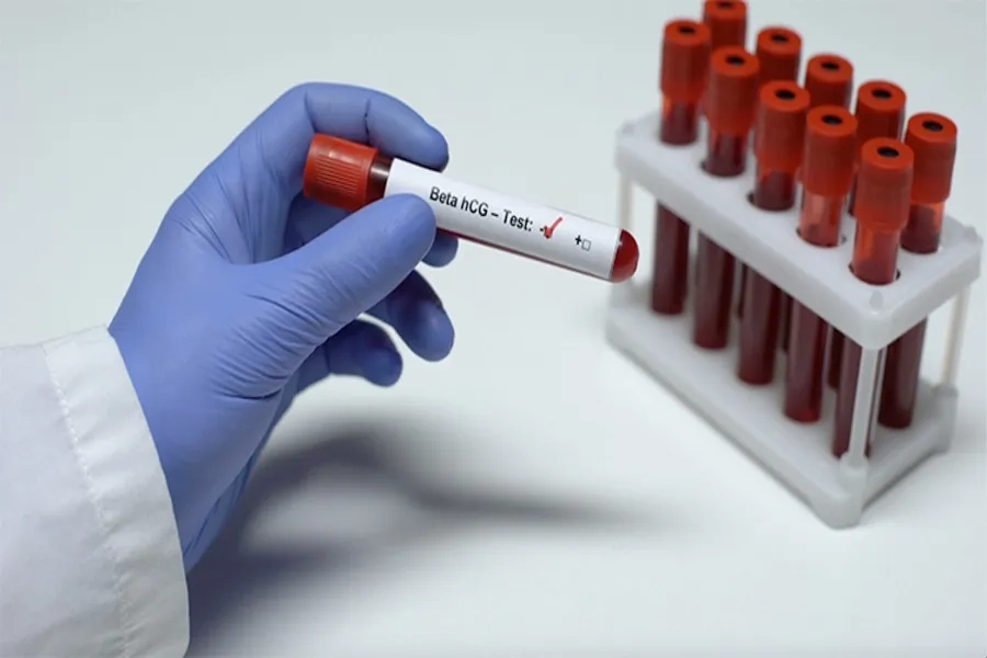 Xét nghiệm beta hCG lấy mẫu máu của mẹ để xác định bạn có mang thai hay không