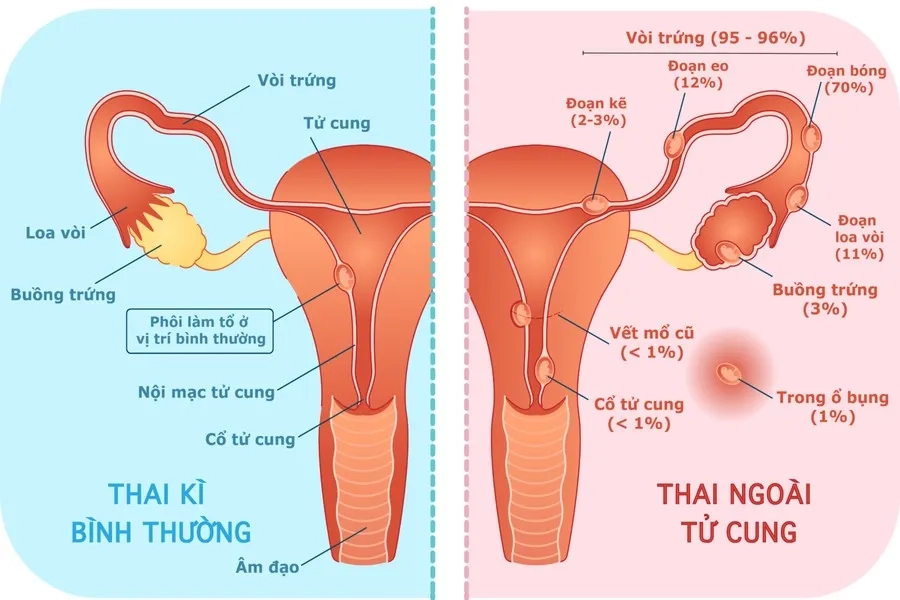 Hormone hCG tăng chậm hoặc không đạt mức nhân đôi