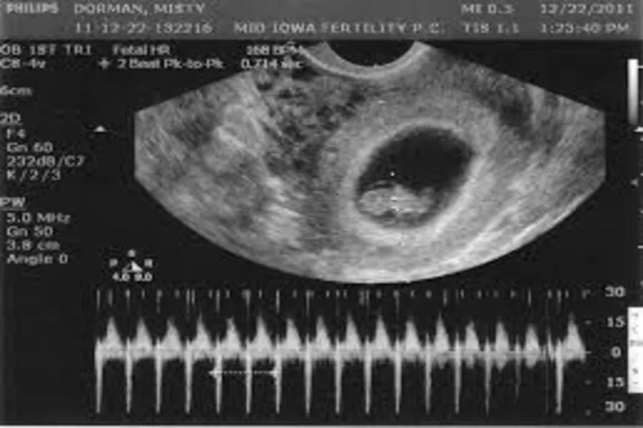 Chỉ số HCG giảm dần theo thời gian