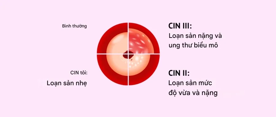 CIN 2 ảnh hưởng đến khoảng ⅓ - ⅔ chiều dày biểu mô cổ tử cung
