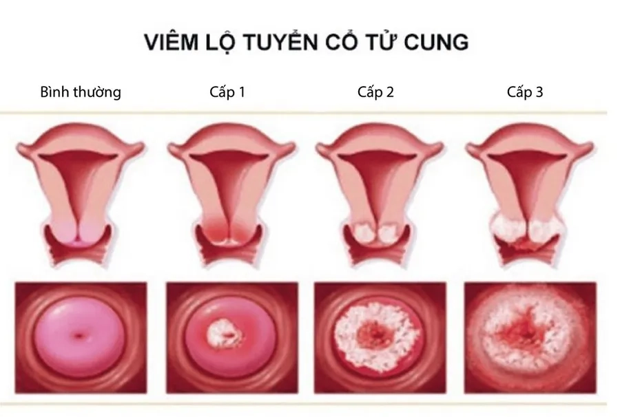 Viêm lộ tuyến xảy ra khi các tế bào tuyến trong ống cổ tử cung lan ra bề mặt bên ngoài và bị viêm nhiễm