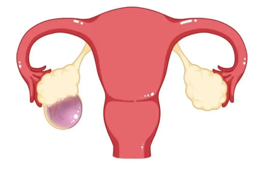 U tế bào mầm buồng trứng có thể khiến chỉ số hCG tăng vọt bất thường