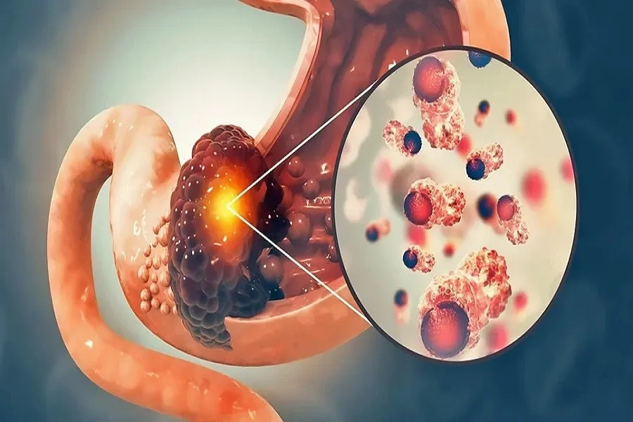 Phân loại theo giai đoạn TNM giúp xác định mức độ xâm lấn và di căn