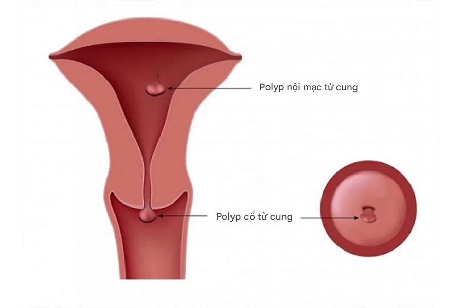 Hình ảnh minh họa vị trí polyp nội mạc tử cung và polyp cổ tử cung