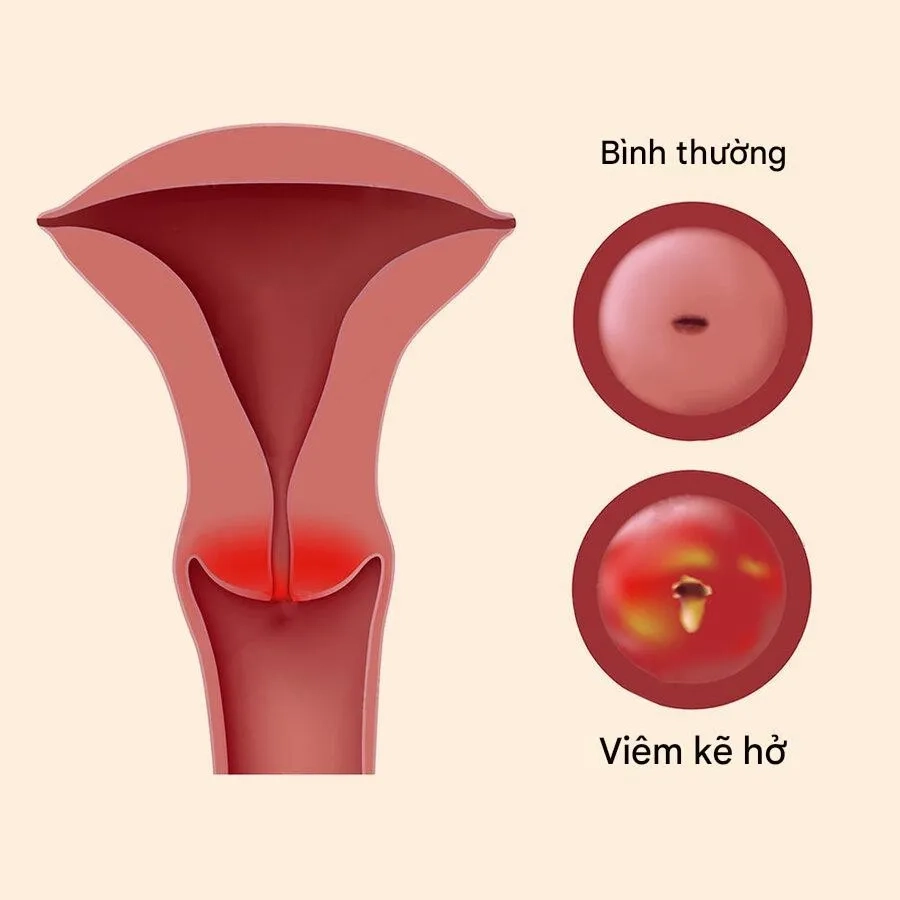 Viêm cổ tử cung mạn tính là nguyên nhân thường gặp liên quan đến sự hình thành polyp
