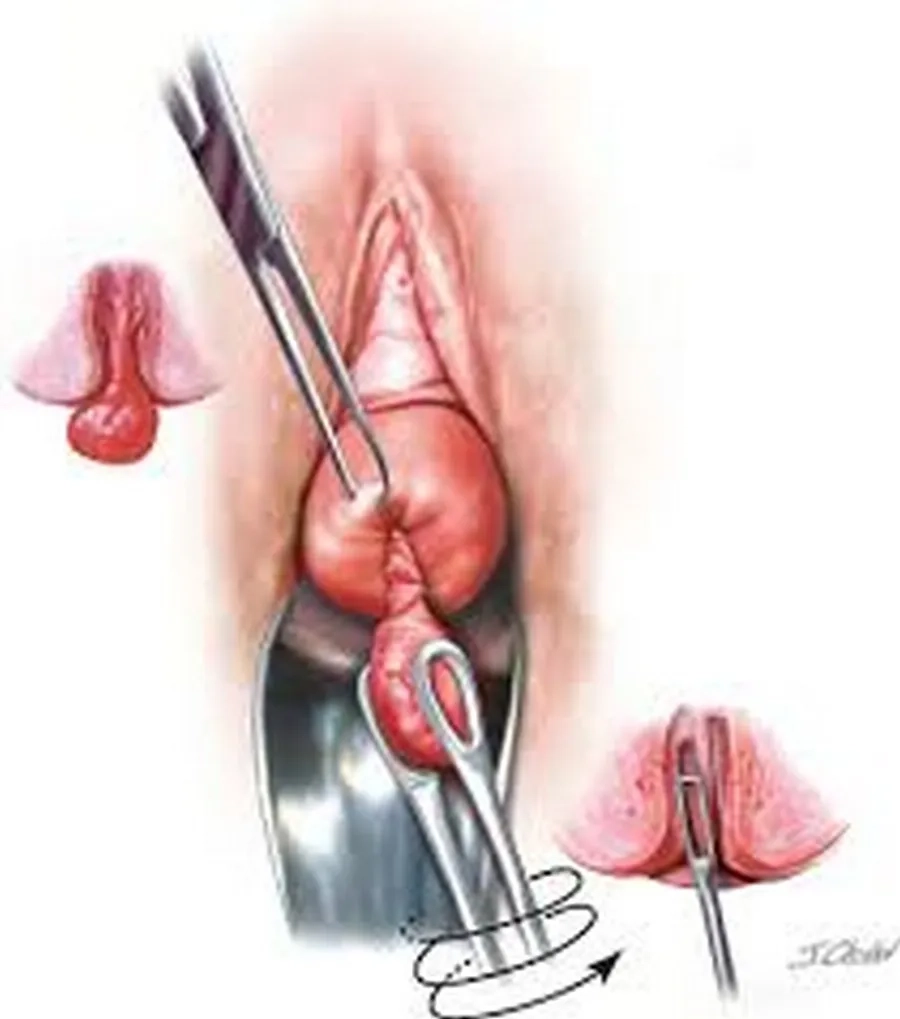 Xoắn polyp là thủ thuật can thiệp đơn giản, ít xâm lấn