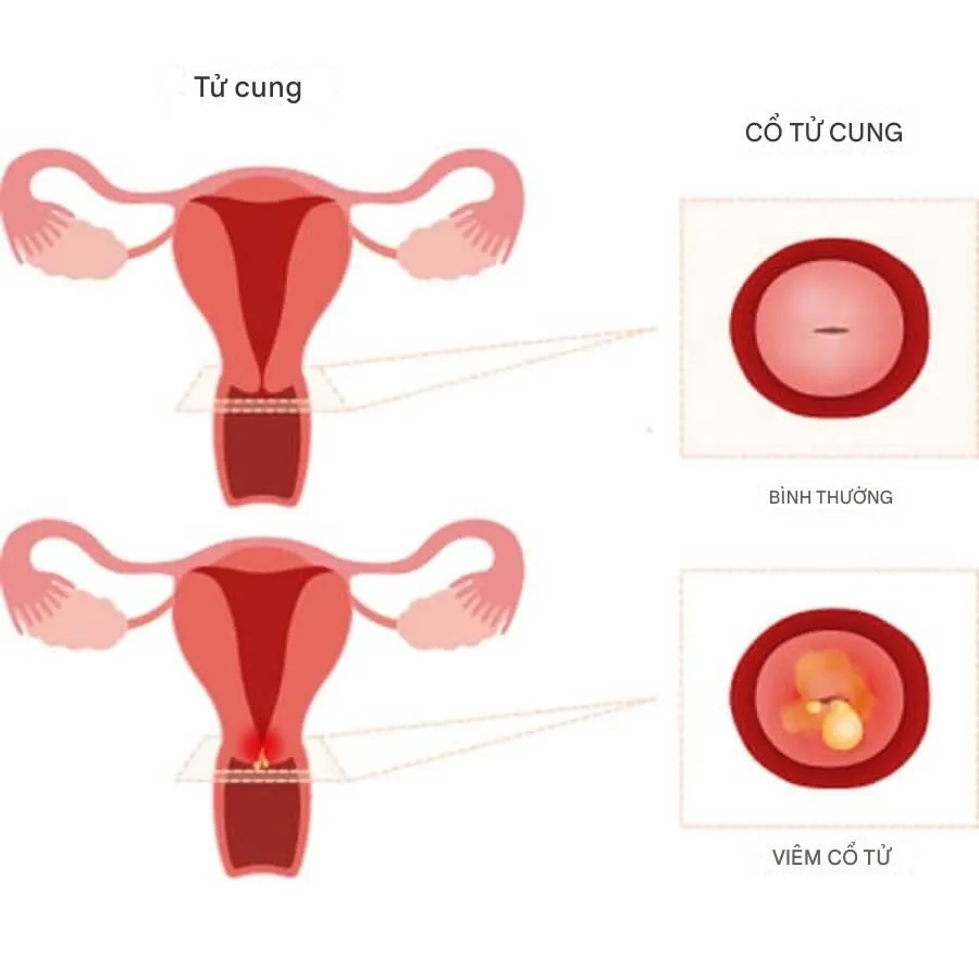 Tình trạng viêm ở cổ tử cung có thể gặp ở nhiều đối tượng, đặc biệt là phụ nữ trong độ tuổi sinh sản
