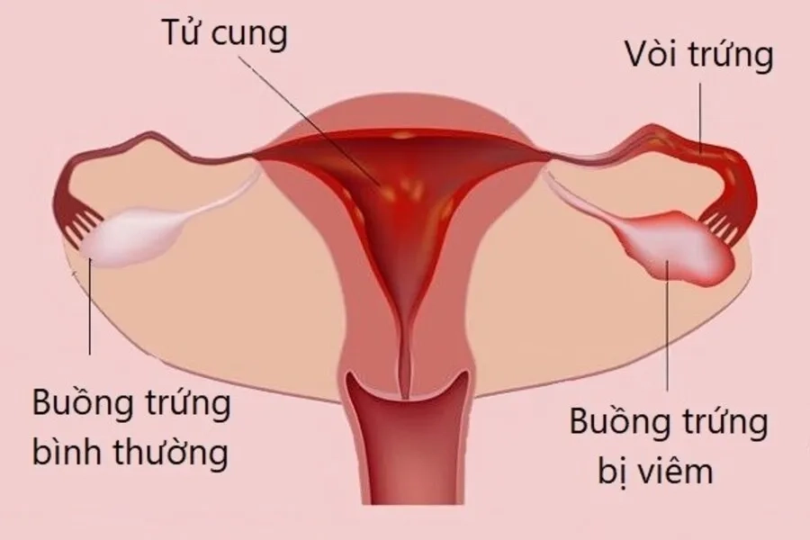 Viêm tại buồng trứng có thể gây ảnh hưởng đến nội tiết và sinh sản